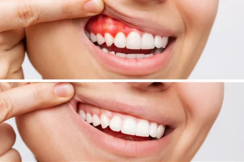 Bleeding Gum