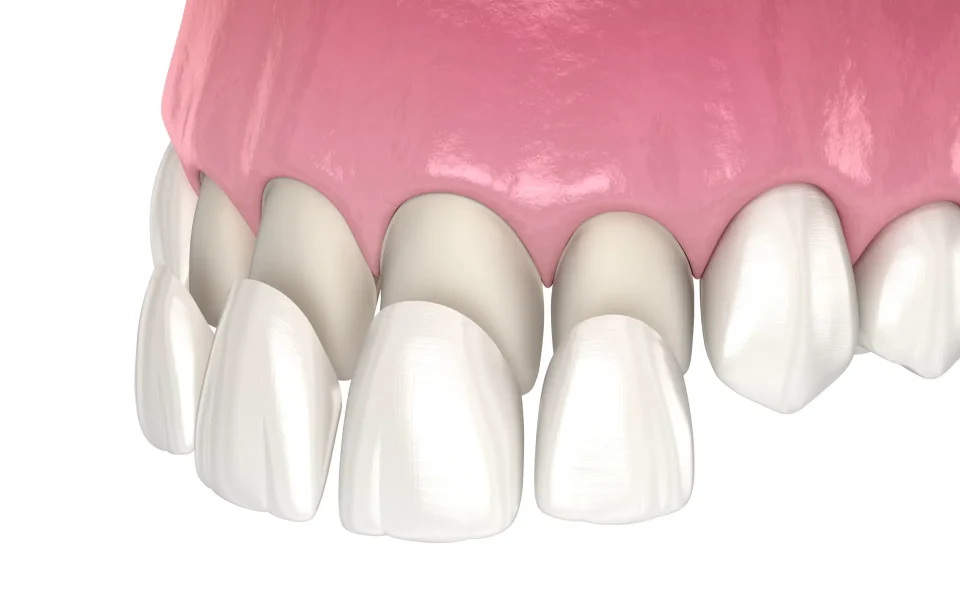 Composite Veneers