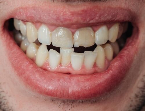 What Treatments Can Be Used For A Chipped Tooth?