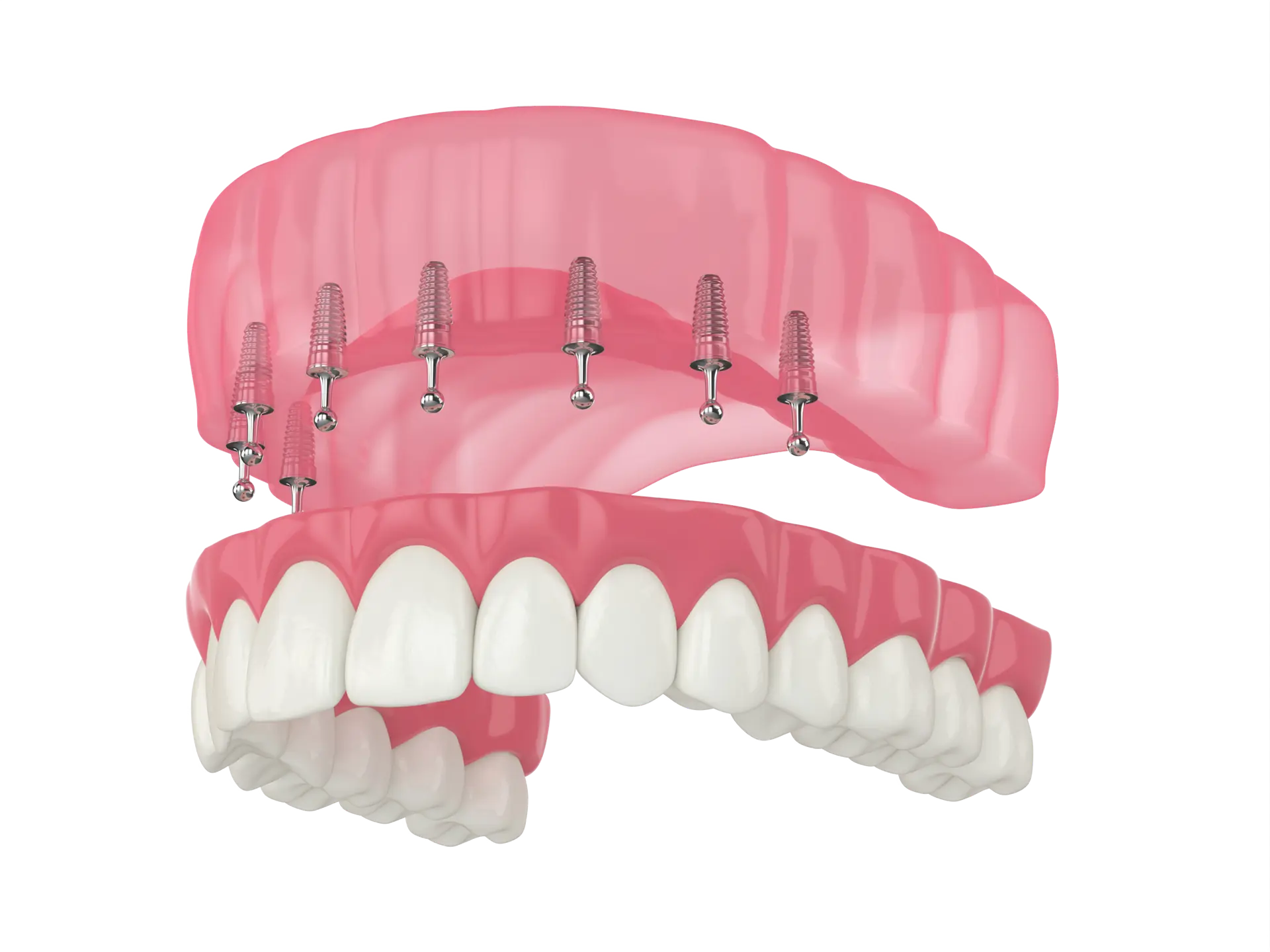 3D Render Full Implant