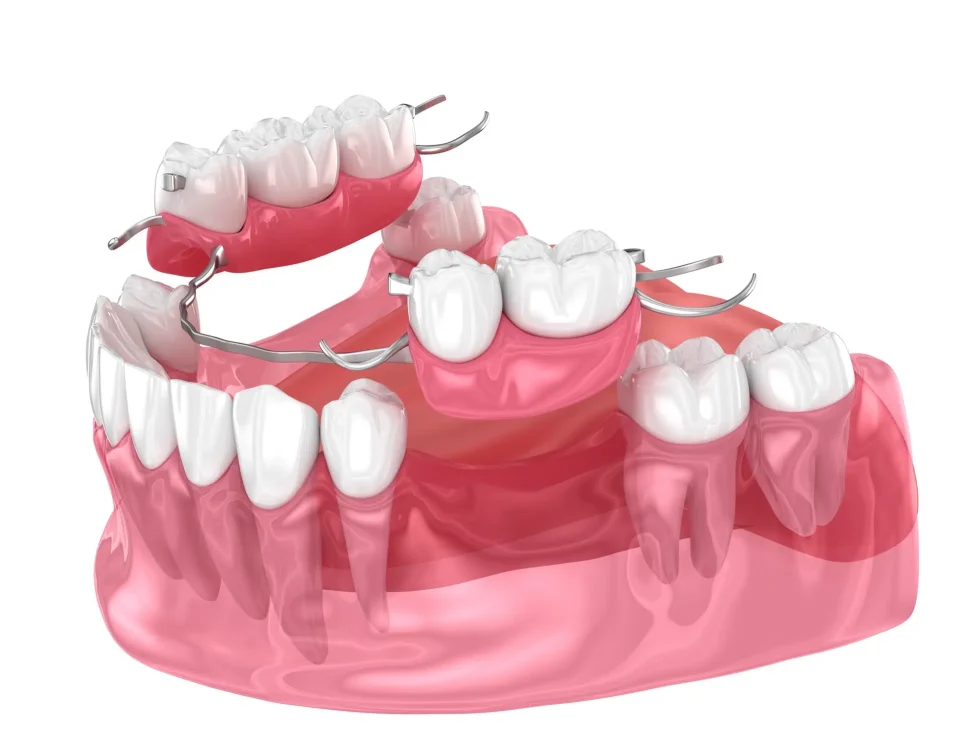 4 - What is a Dental Bridge