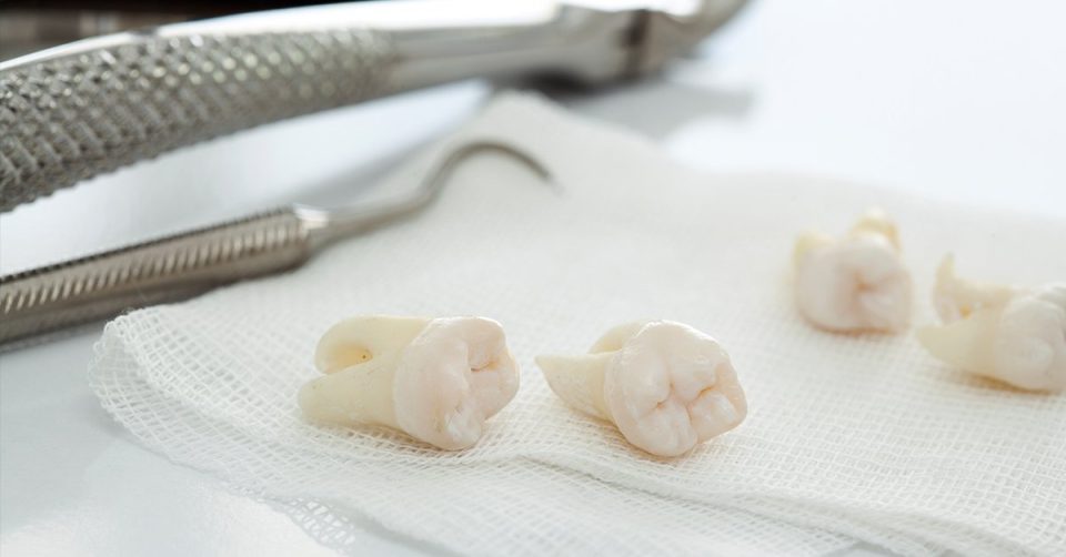 Preparing for a Tooth Extraction