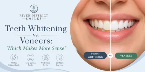 teeth whitenning vs veneers