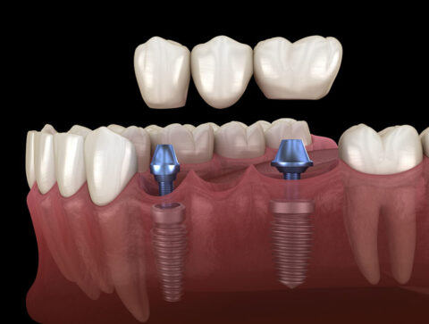 implant bridge diagram