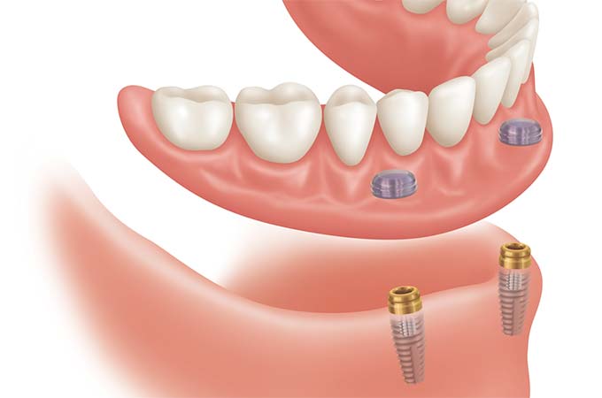 lower locator denture