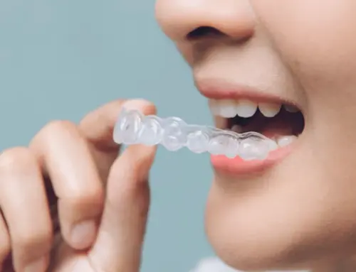 Rock Hill SC’s Clear Aligners: Transforming Smiles with Precision