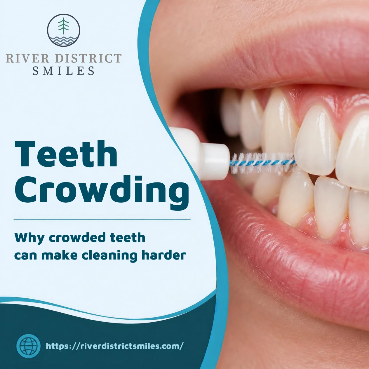 Teeth Crowding: Why It Can Make Cleaning Harder