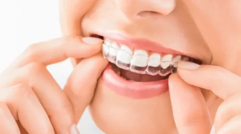 video-thumbnail-sure-smile-clear-aligners